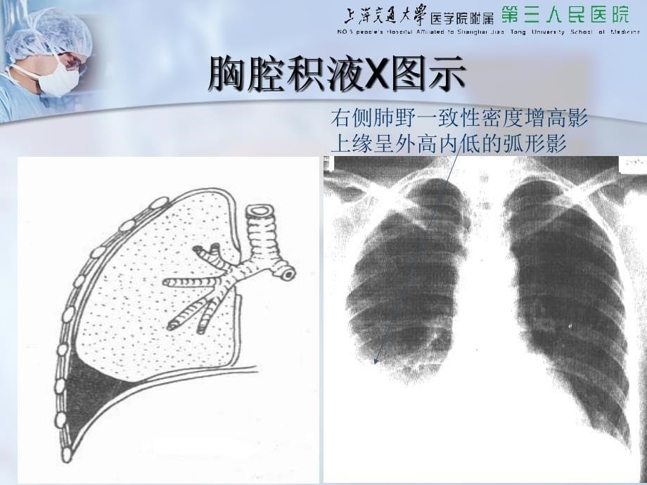 胸穿腹穿骨穿腰穿四大穿刺_第5页