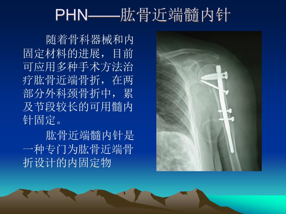 应用髓内针治疗肱骨外科颈骨折ppt课件_第3页