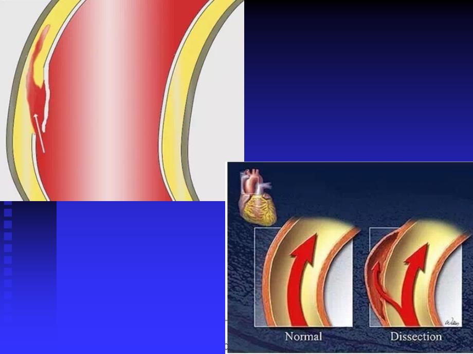 主动脉夹层影像ppt课件_第3页
