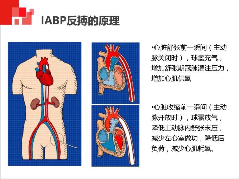 主动脉球囊反搏术(iabp)监测与护理_第5页