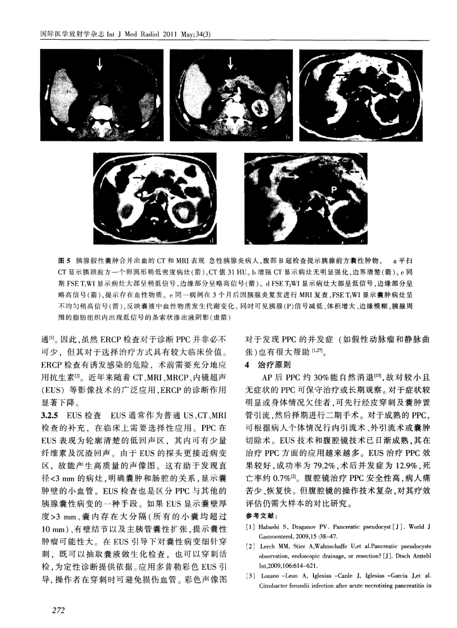 急性胰腺炎后胰腺假性囊肿的影像表现_第4页