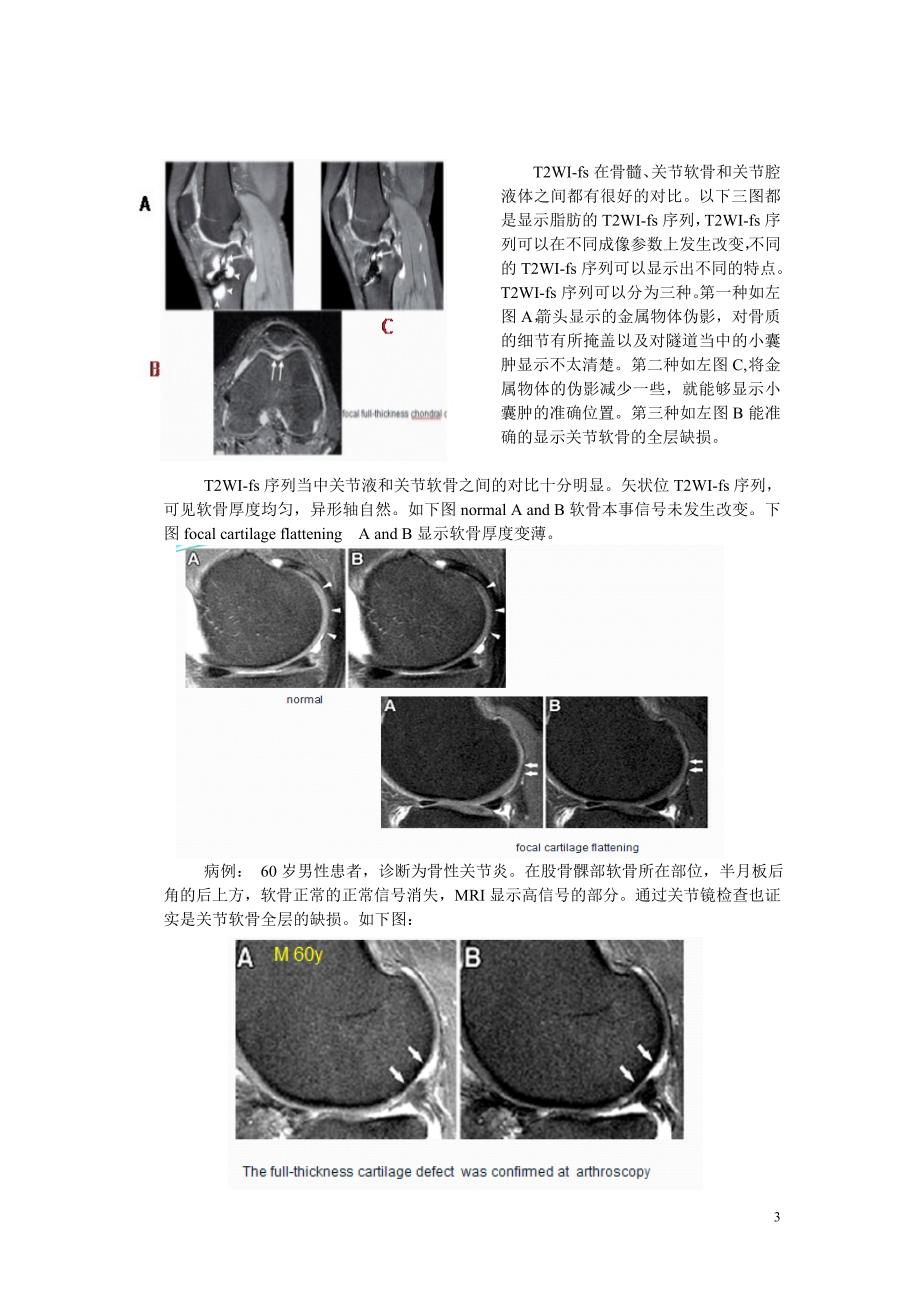 MRI对膝关节软骨损伤诊断_第3页