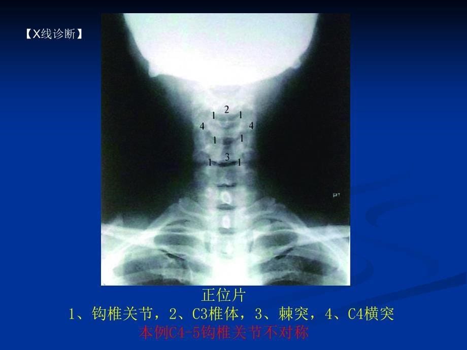 脊柱影像阅读入门(周标)_第5页