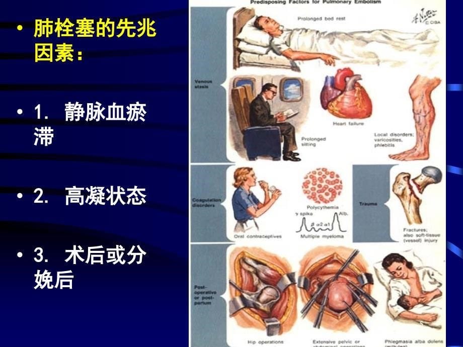 肺栓塞---北京协和医院_第5页