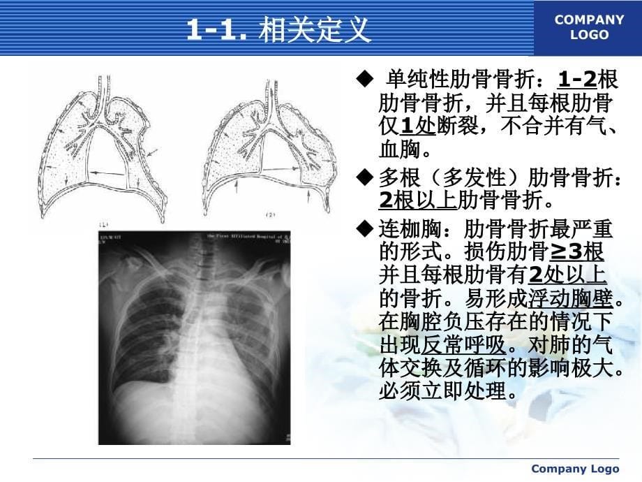 肋骨骨折外科治疗_第5页