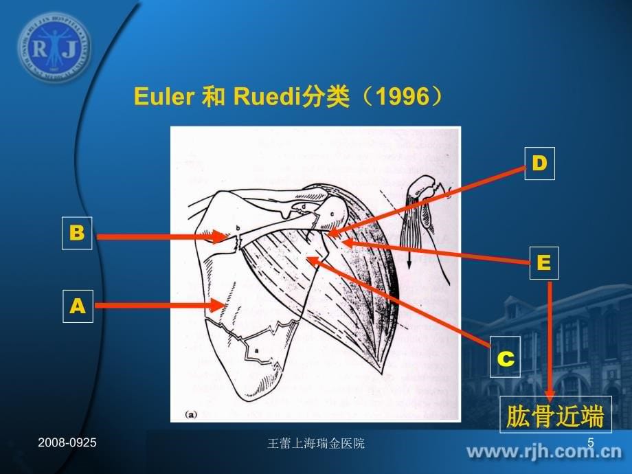 肩胛骨骨折治疗_第5页