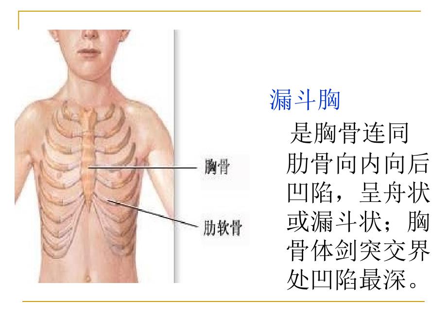 漏斗胸-_第3页