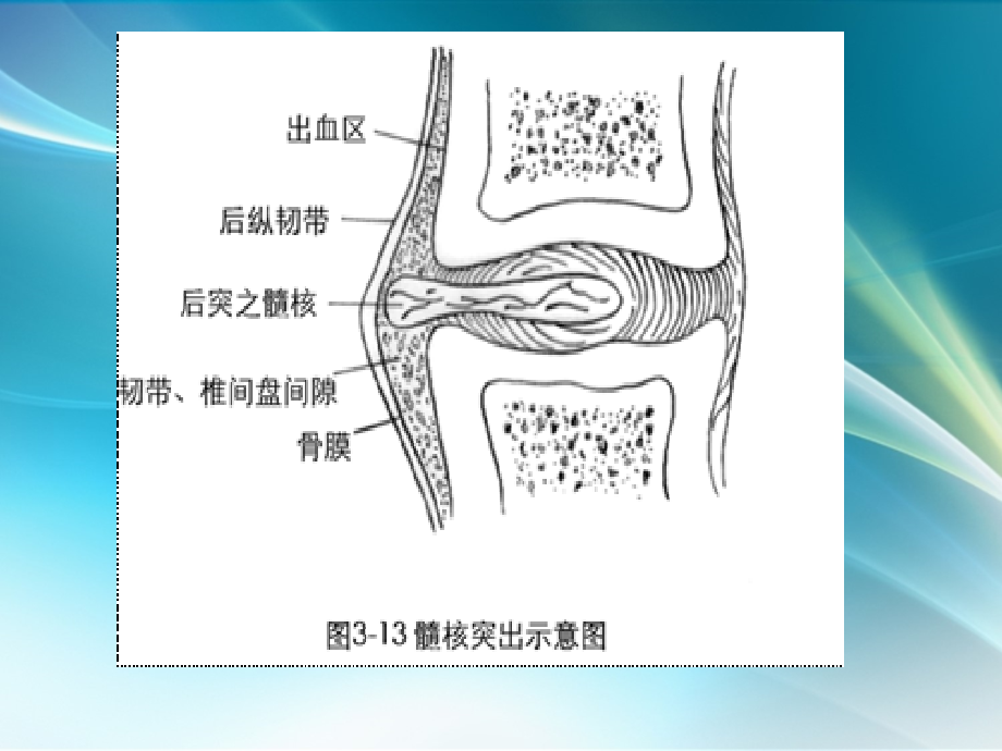 课件：颈椎病知识_第3页