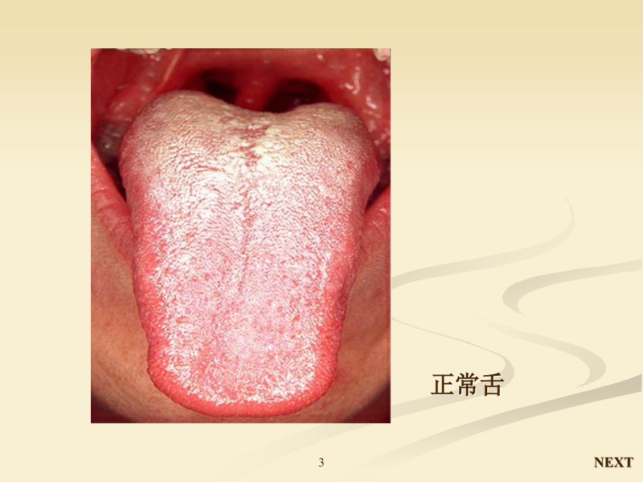 课件：舌疾病ppt课件_第3页