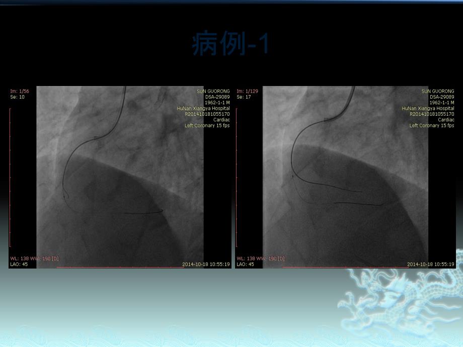 课件：ivus在cto病变中应用ppt课件_第4页