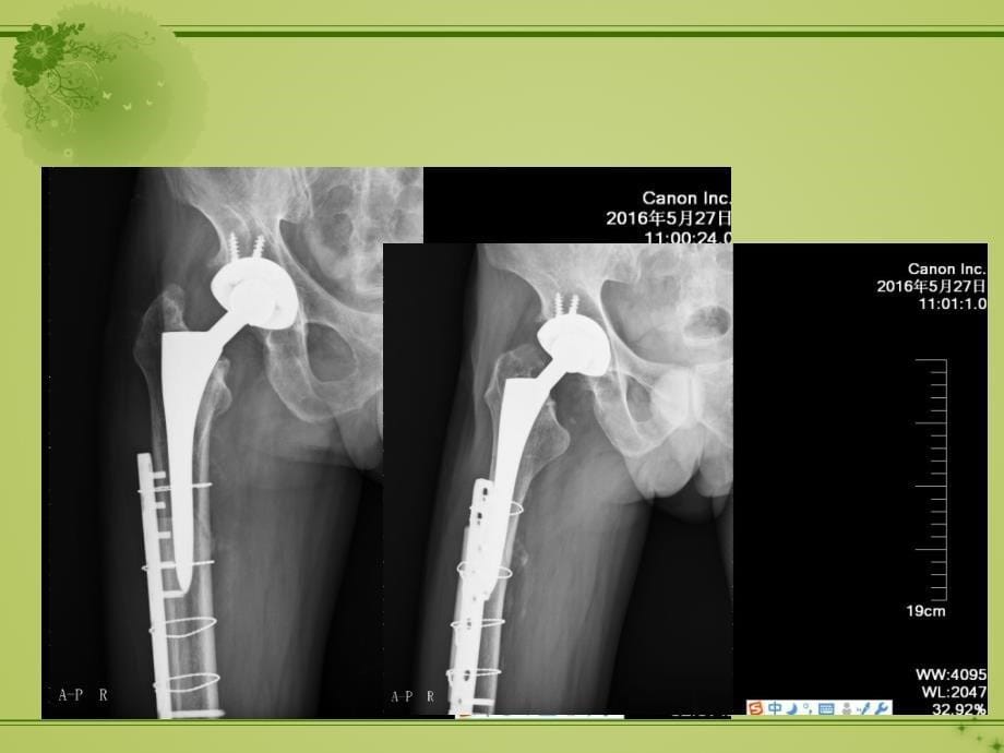 课件：髋关节假体周围骨折的诊治_第5页