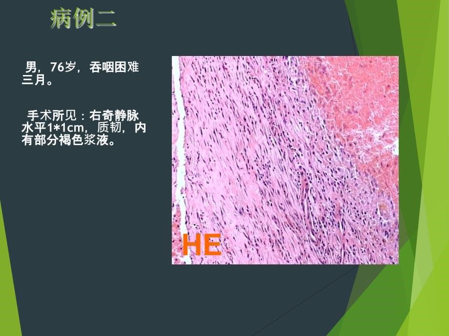 【ppt课件】消化道黏膜隆起性病变的超声内镜诊断_第5页