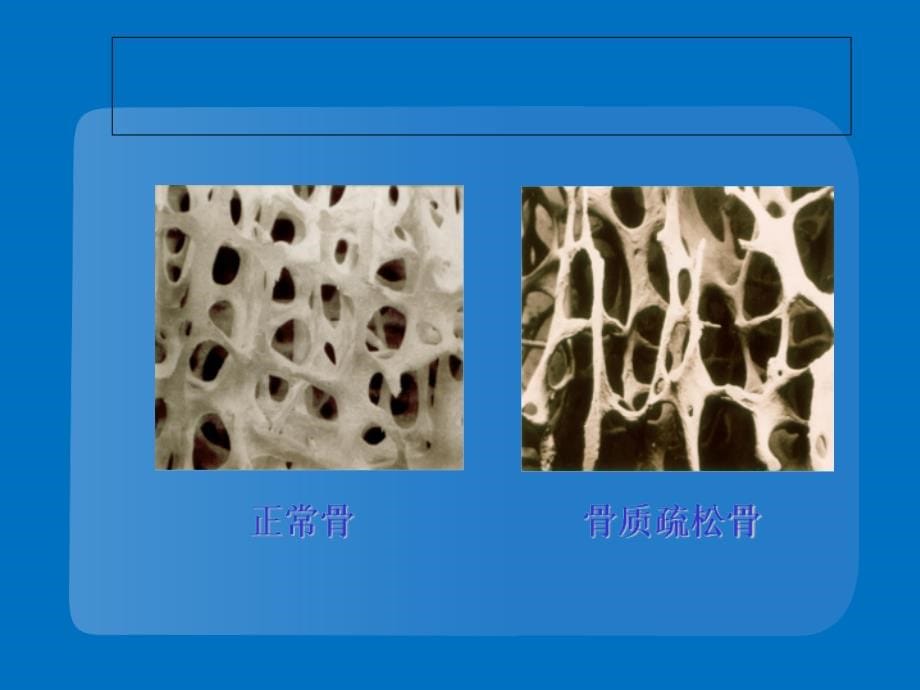 骨质疏松预防及用药注意事项_第5页