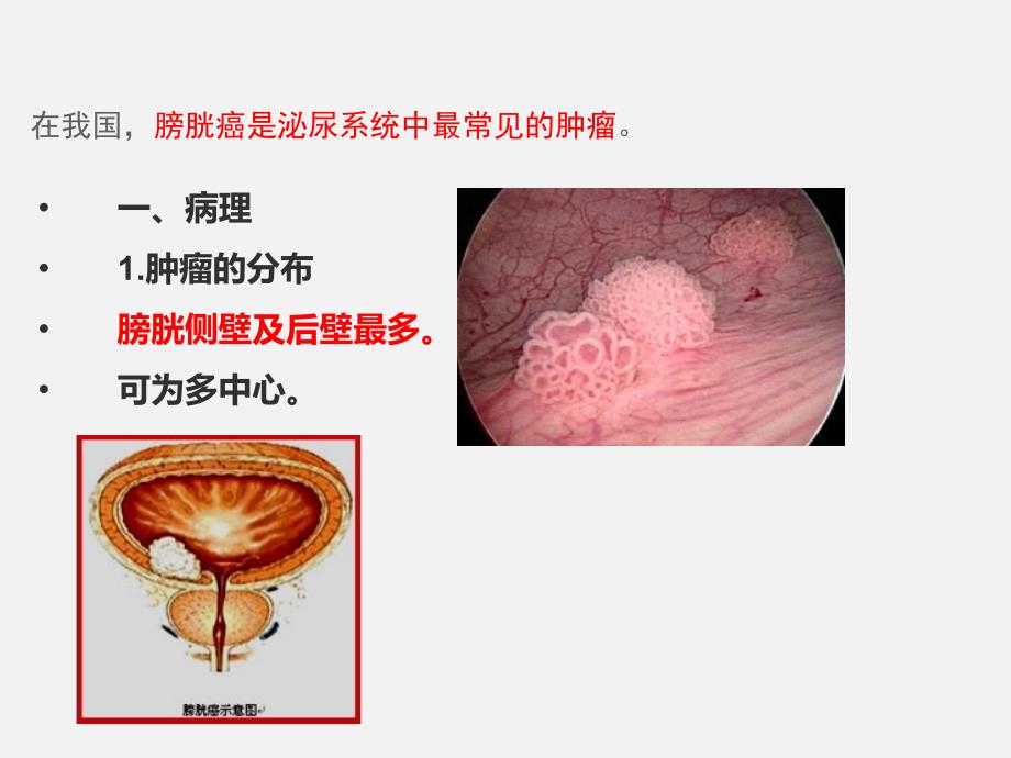 膀胱癌、鞘膜积液_第3页