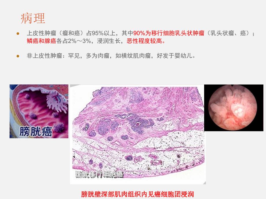 膀胱癌、鞘膜积液_第4页