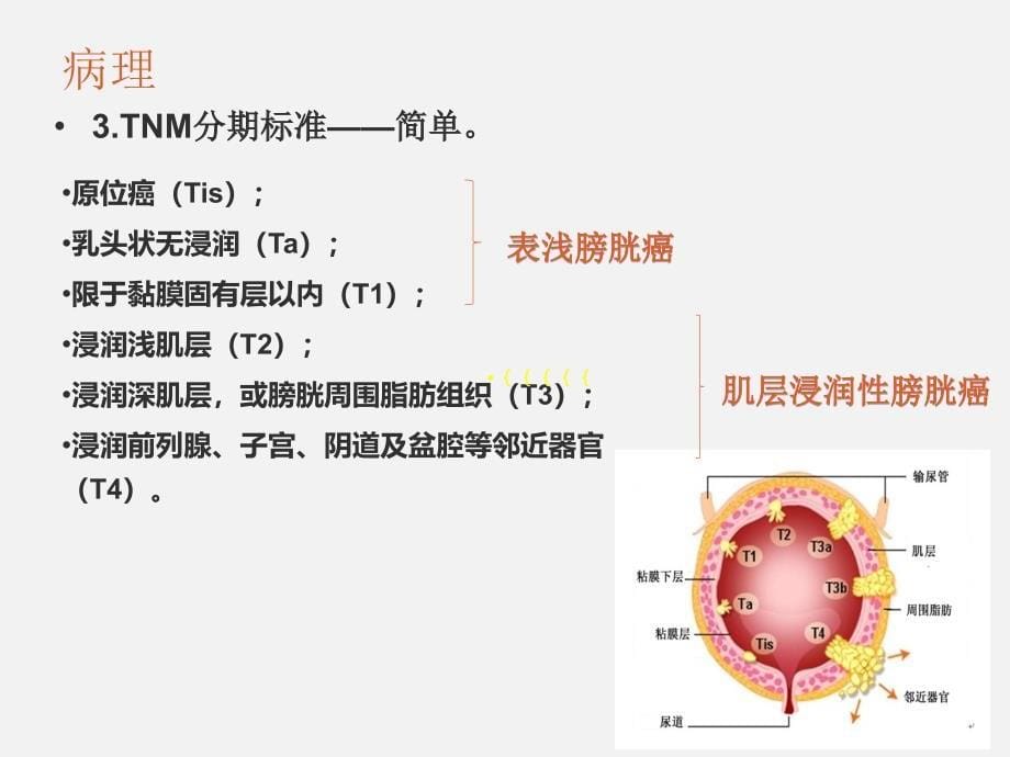 膀胱癌、鞘膜积液_第5页