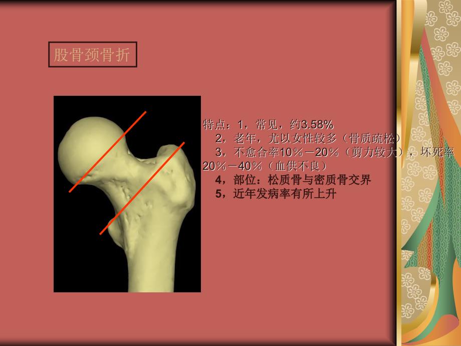 股骨颈骨折.尚志恒_第3页