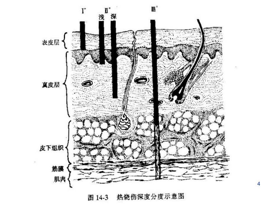 课件：烧伤病理分析ppt课件_第4页