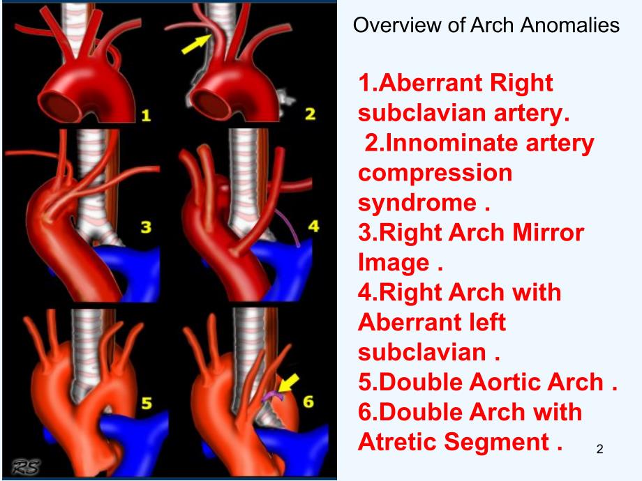 主动脉血管变异，肺动静脉英文课件_第2页