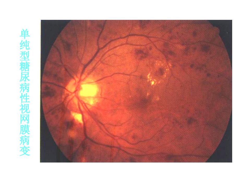 单纯型糖尿病性视网膜病变_第2页