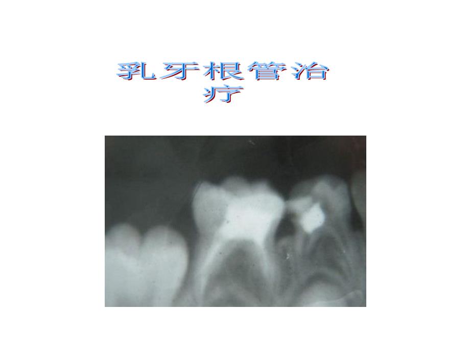 乳牙根管治疗_第1页