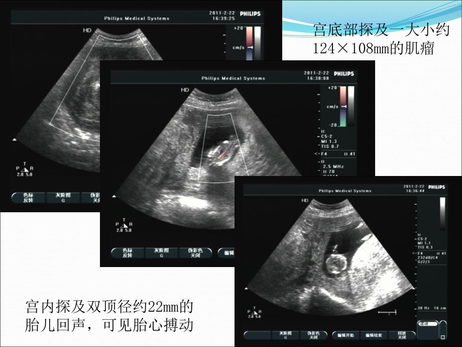 课件：宫内异位妊娠_第4页