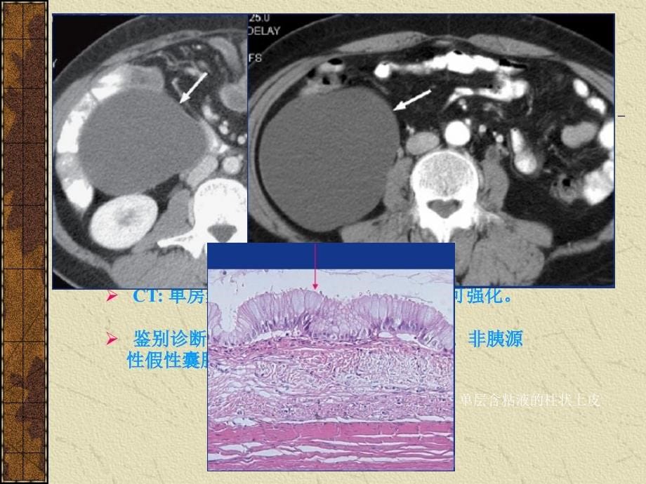 课件：腹膜后间隙病变的影像诊断 锋版_第5页