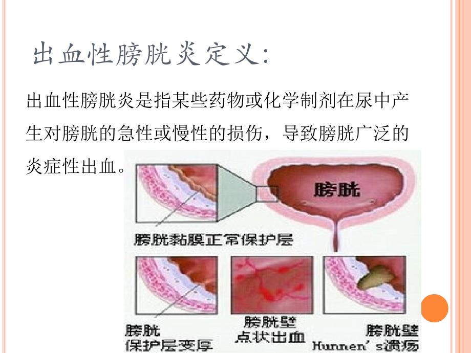 课件：化疗所致出血性膀胱炎的护理_第3页