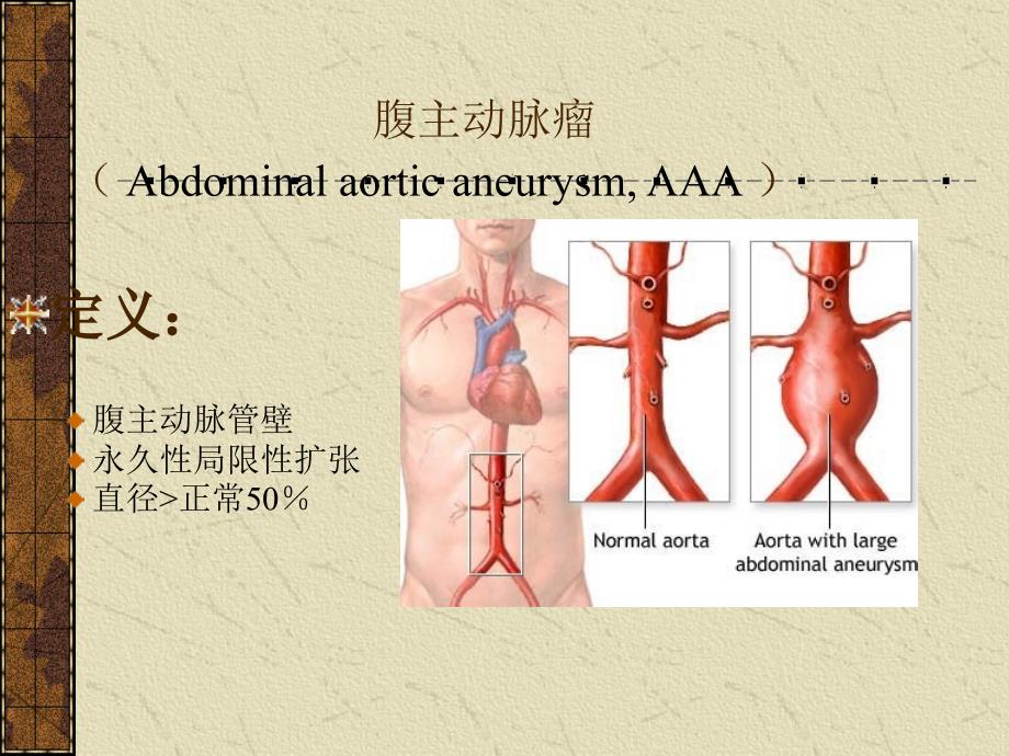 课件：腹主动脉瘤之诊断与治疗_第4页