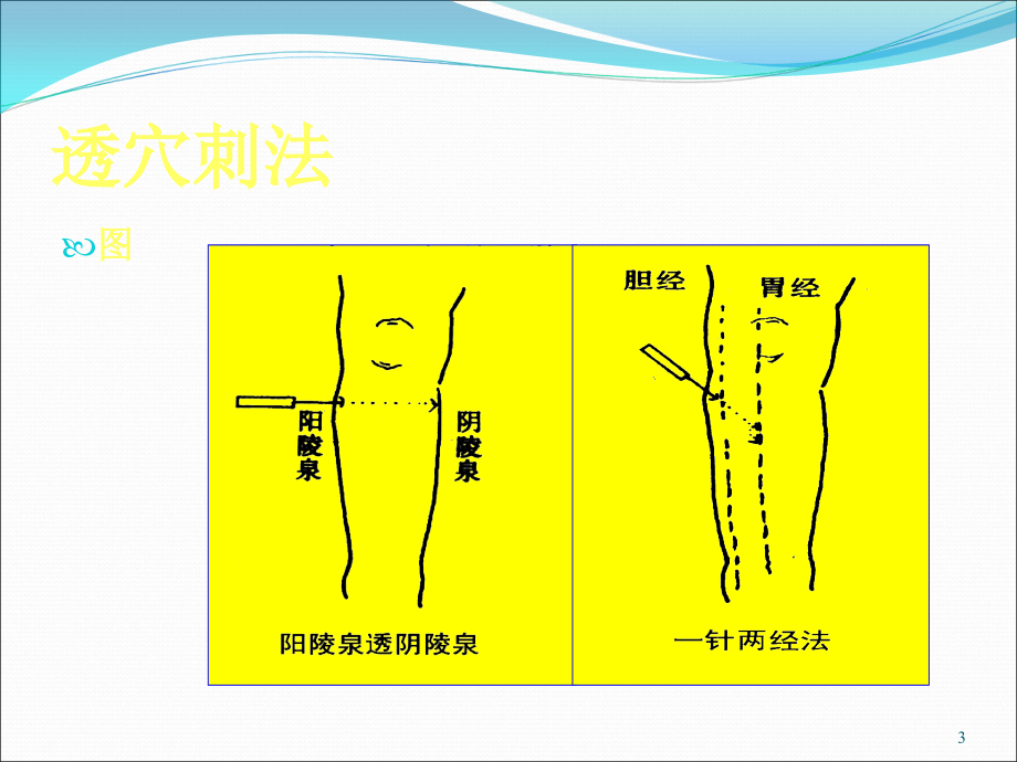 课件：毫针刺法的临床应用 (2)_第3页