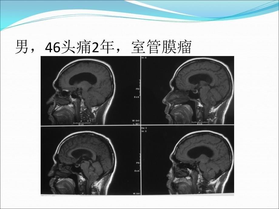 课件：后颅窝肿瘤_第5页