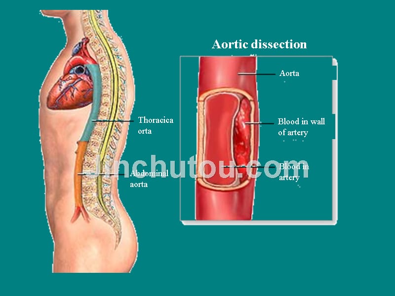 课件：主动脉夹层ppt_第4页
