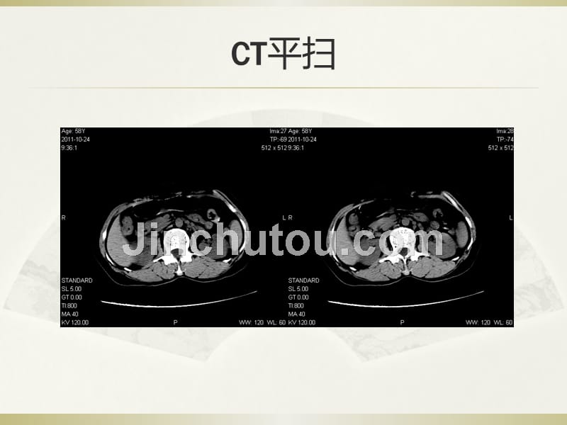 课件：读片-胃部血管球瘤影像特征及鉴别诊断_第2页