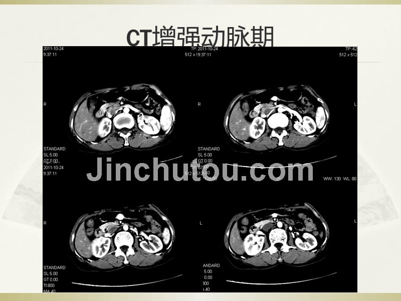 课件：读片-胃部血管球瘤影像特征及鉴别诊断_第3页