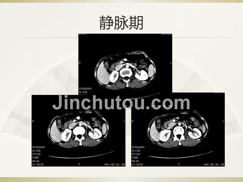 课件：读片-胃部血管球瘤影像特征及鉴别诊断_第4页