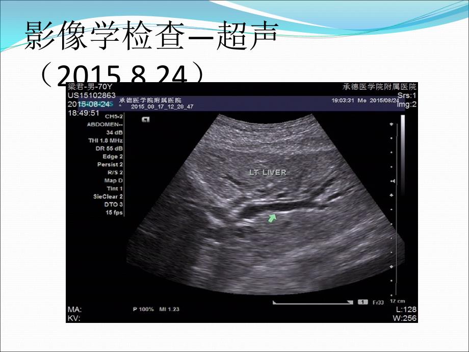 课件：壶腹周围癌——病例讨论_第4页