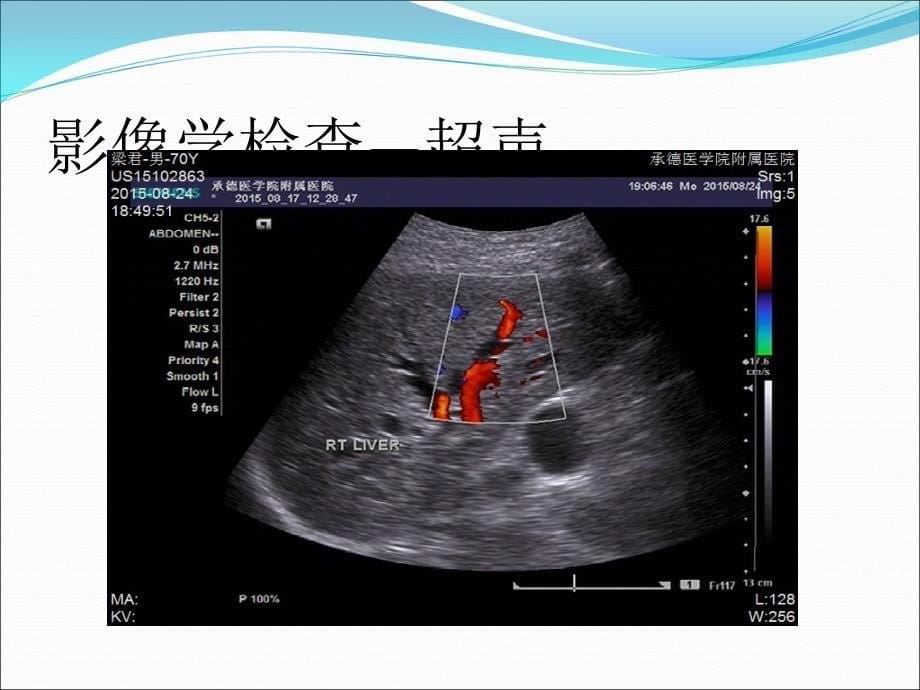 课件：壶腹周围癌——病例讨论_第5页