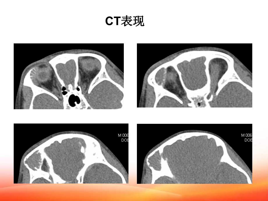 课件：骨化性纤维瘤_第3页