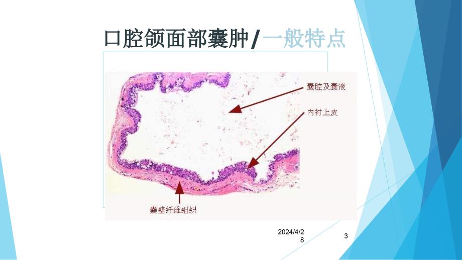 课件：口腔颌面囊肿_第3页