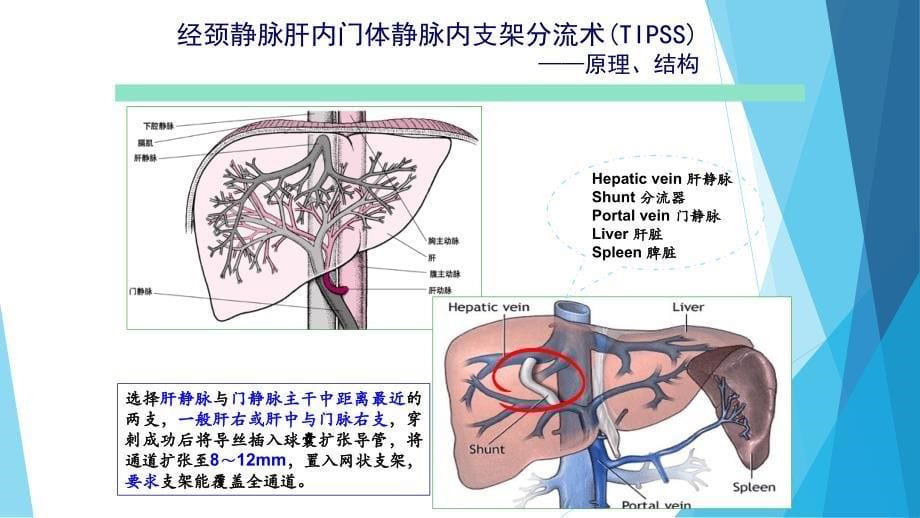 课件：经颈静脉肝内门体分流术(tips)_第5页