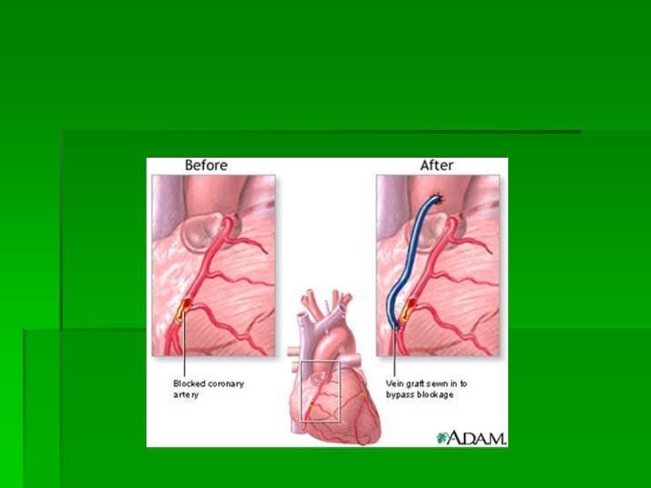课件：冠脉搭桥术健康宣教_第5页