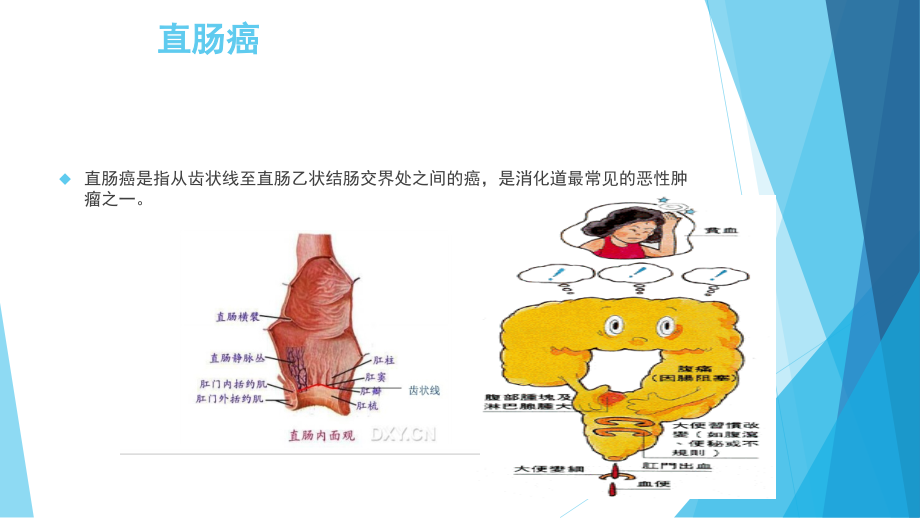 课件：教学查房直肠癌围手术期护理介绍_第3页