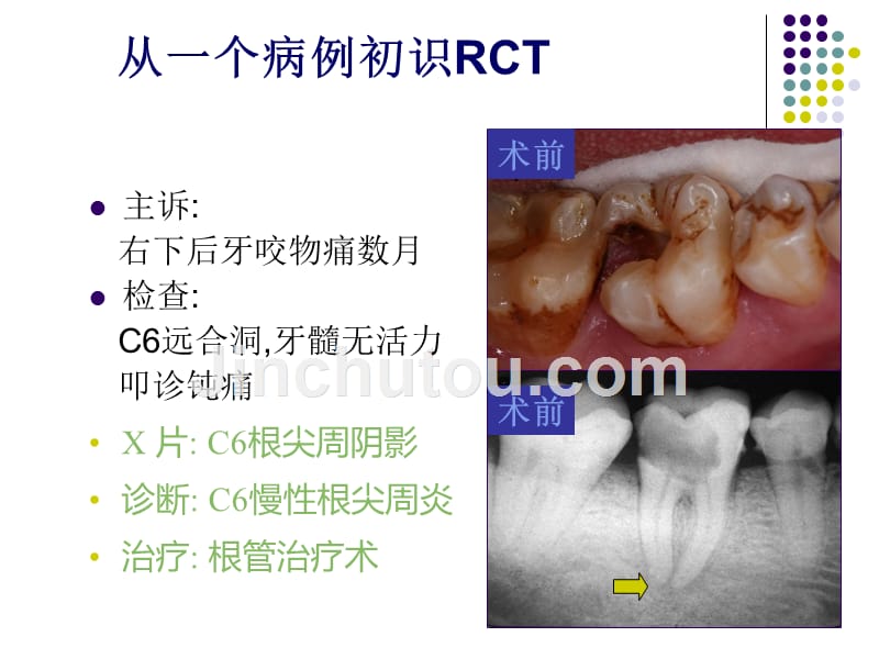 课件：根管治疗rct _第4页