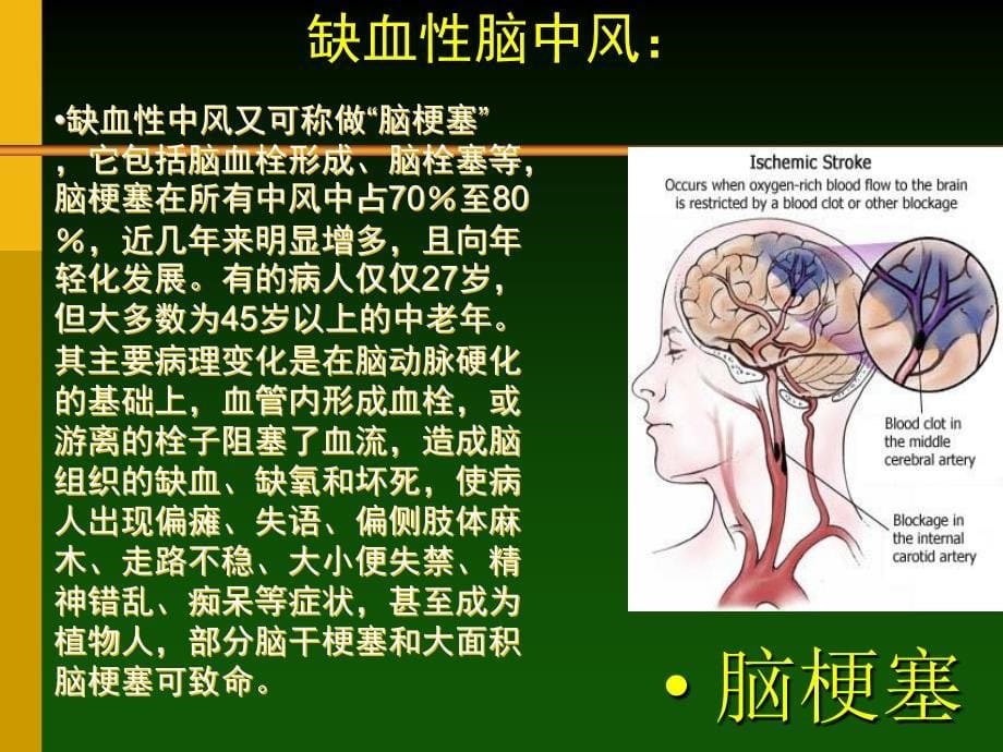 课件：脑中风_第5页