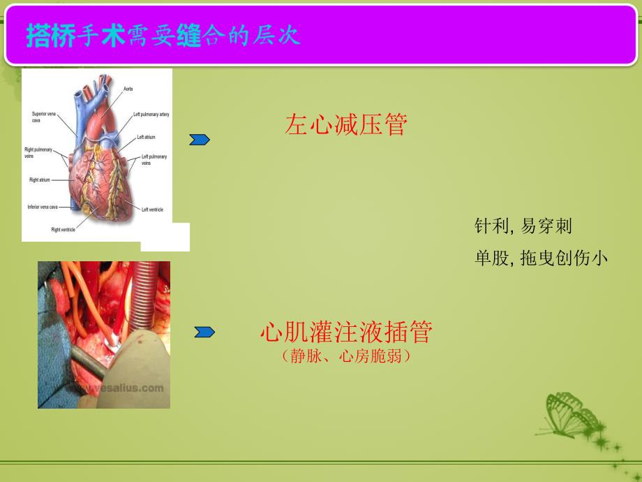 课件：cv 搭桥对针线的选择_第4页