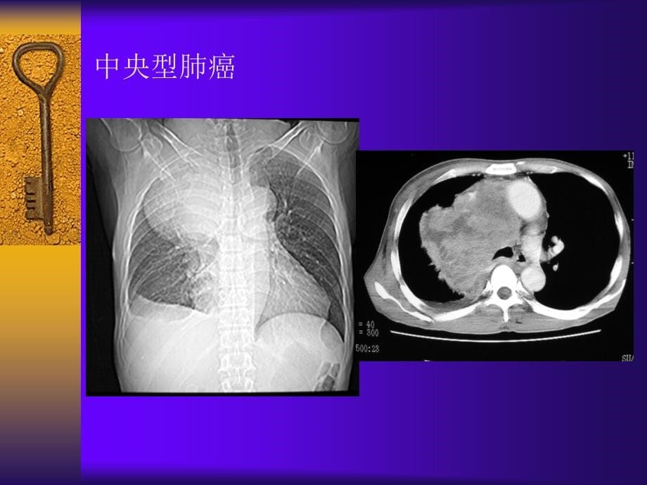 肺癌ct诊断04479_第5页