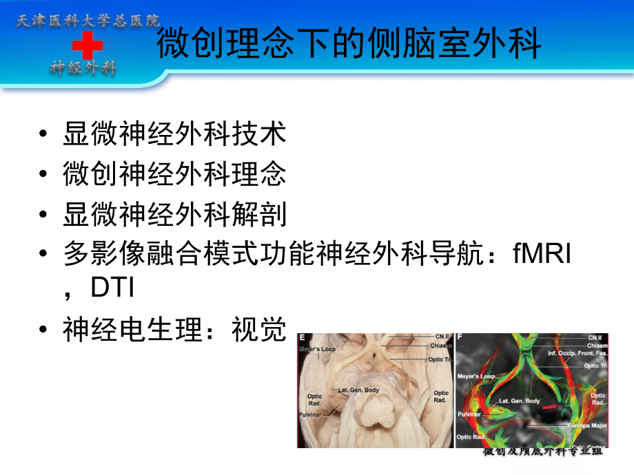 侧脑室手术入路及技术_第2页