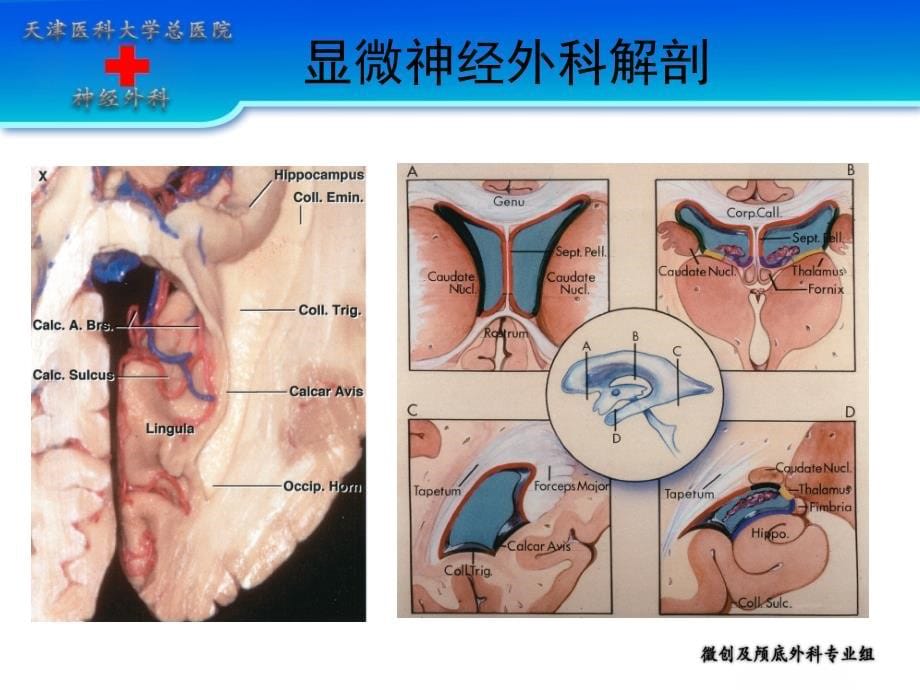 侧脑室手术入路及技术_第5页