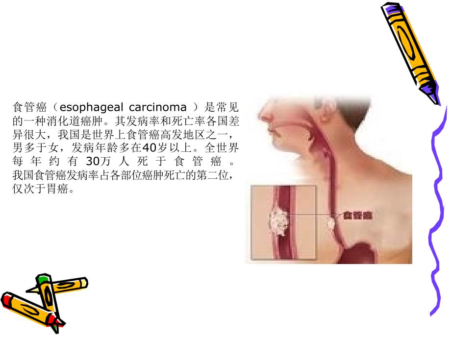 食道癌与术前术后护理_第2页