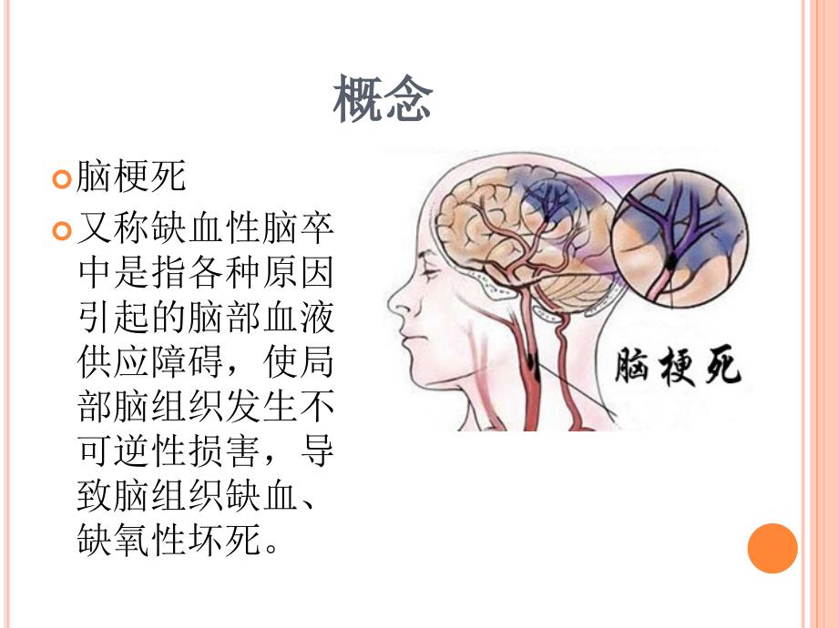 急性缺血性脑卒中静脉溶栓临床应用与护理_第4页